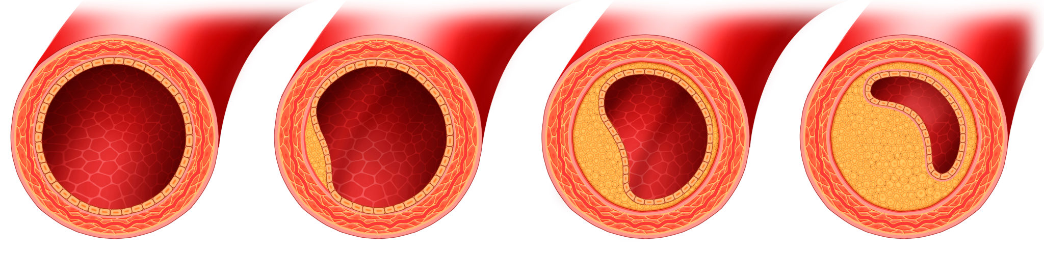 South Park Vascular Care | Peripheral Arterial Disease Management